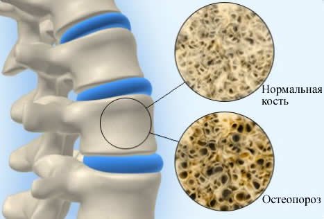 Причины симптомы и профилактика остеопороза