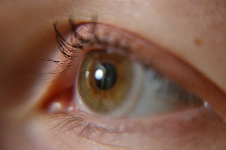 Воспаление Века Глаза – Симптомы И Лечение