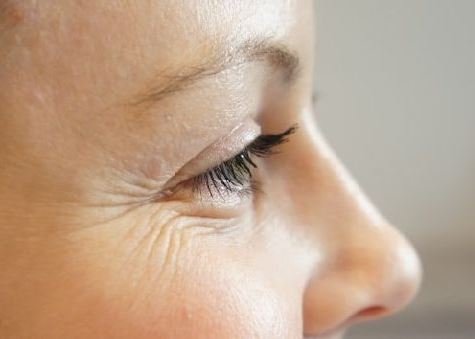 Как убрать морщины вокруг глаз: от компрессов до уколов