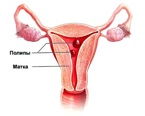 Симтомы и лечение полипа матки