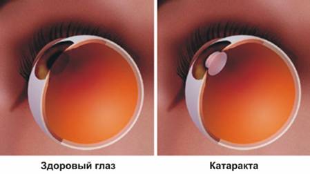 Народные средства от катаракты