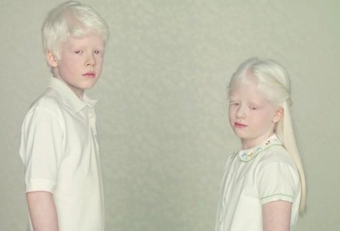 Признаки Альбинизма у Детей и Осложнения Заболевания