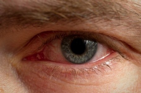 Симптомы И Лечение Блефарита Глаз