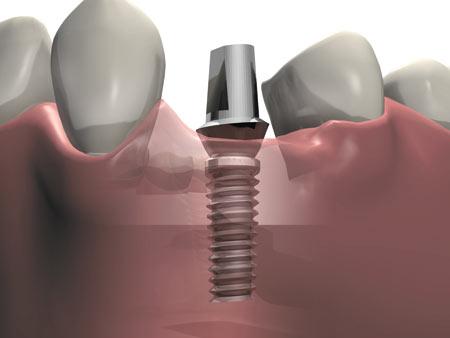 Имплантация зубов: особенности процедуры и виды имплантатов