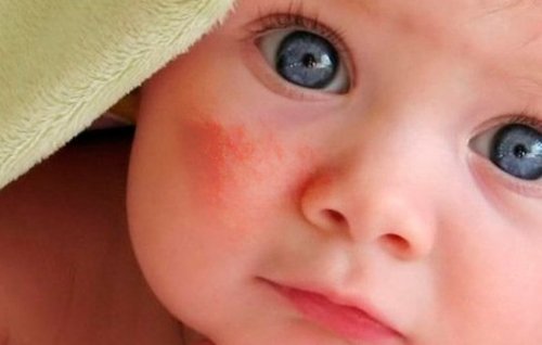 Сыпь на лице у новорождённого — причины