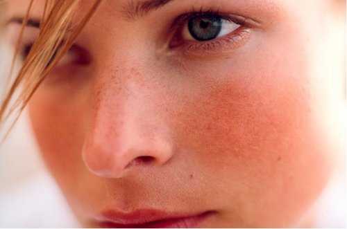 Розацеа на лице - первые симптомы, стадии, причины и возможные осложнения