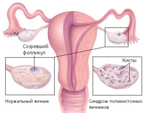 Симптомы и методы лечения поликистоза яичников у женщин