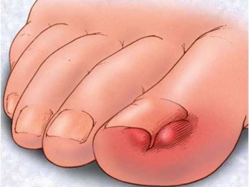 Панариций пальца ноги: лечить в домашних условиях или бежать к врачу?