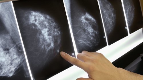 Парабены и рак молочной железы: есть ли связь?