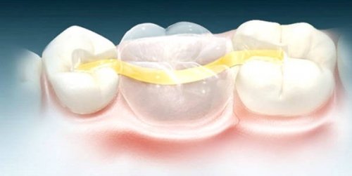 Микропротезирование зубов – способ вернуть улыбке красоту