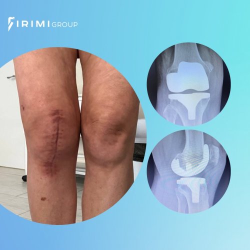 Эндопротезирование коленного сустава: что это?